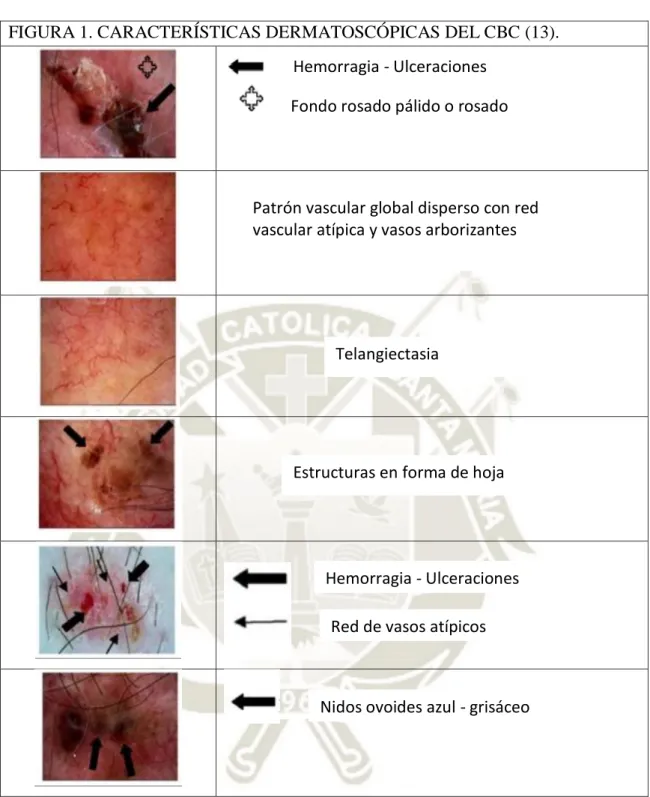 FIGURA 1. CARACTERÍSTICAS DERMATOSCÓPICAS DEL CBC (13). 