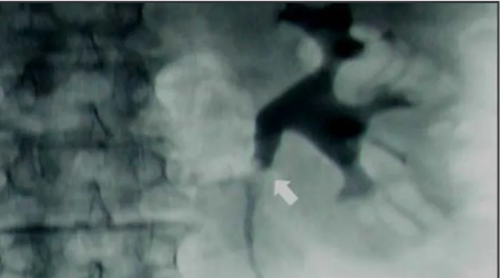 Figura 1: Urografía intravenosa donde se observa un defecto de  repleción  a  nivel  del  uréter  proximal  izquierdo  compatible  con  tumor del tracto urinario superior.