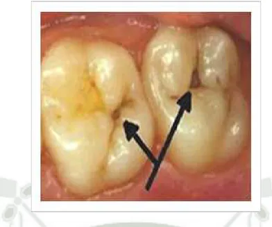 Figura  2:  Lesiones  en  la  superficie  oclusal  de  un  diente  molar,  asociadas a la placa dentro del patro de las fisuras del diente