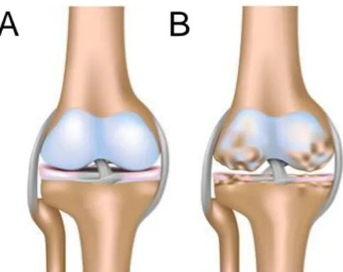 Figura 1.  Representación de la artrosis de  rodilla: Gonartrosis. (A) Rodilla  sana, cartílago  articular  (tejido  representado  de  color  blanco-azulado)  no  lesionado