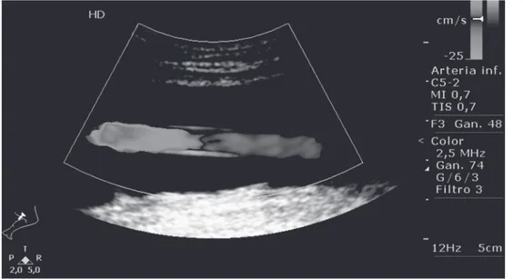 Fig  1.  Imagen  con  ecografía  doppler  color  de  prótesis  vascular permeable, no integrada, rodeada de una gran  masa líquida hipoecogeníca.