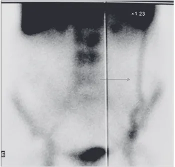 Fig 3. Colección en la anastomosis superior y cuerpo del  injerto  en  TAC  (izquierda)