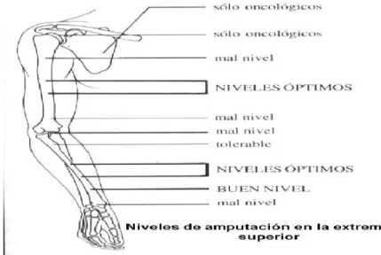 Figura 2. Niveles de Amputación [4]. 