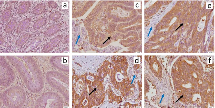 Figure  5.  Immunohistochemical  analysis  of  Hsp90  protein  expression  in  human  samples from colon cancer patients