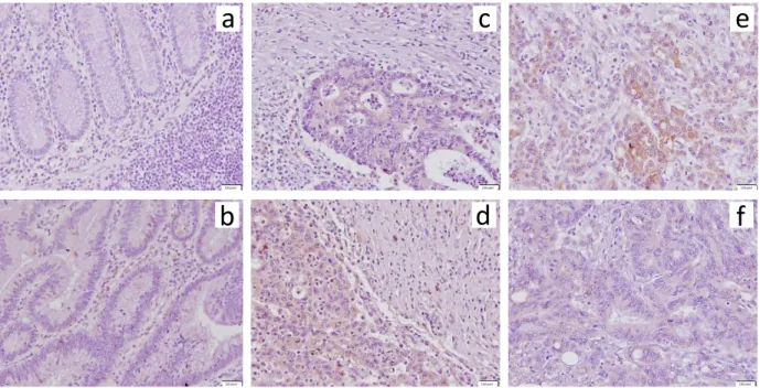 Figure  7.  Immunohistochemical  analysis  of  Hsp70  protein  expression  in  human  samples  from colon cancer patients