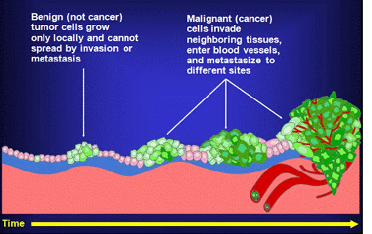 Figure 1. Schematic representation of the  basic  differences  between  a  benign  tumour and a malignant tumour (cancer)