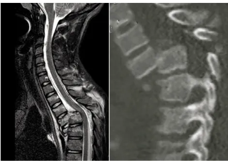 Figura 5: A-Imagen RM en un caso de fractura-luxación D4-D5. B-Reconstrucción sagital de TAC  de la misma lesión 