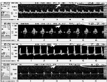 Figura 6. Visualización del proceso de muerte encefálica (ME) en el Doppler  transcraneal: 