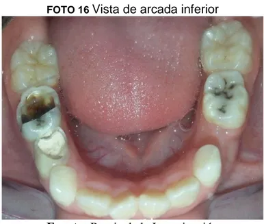 FOTO 16: Vista oclusal inferior presencia de lesiones cariosas en cavidades y  pieza tratada pulparmente ( pasta zinquenolica), carie incipiente  