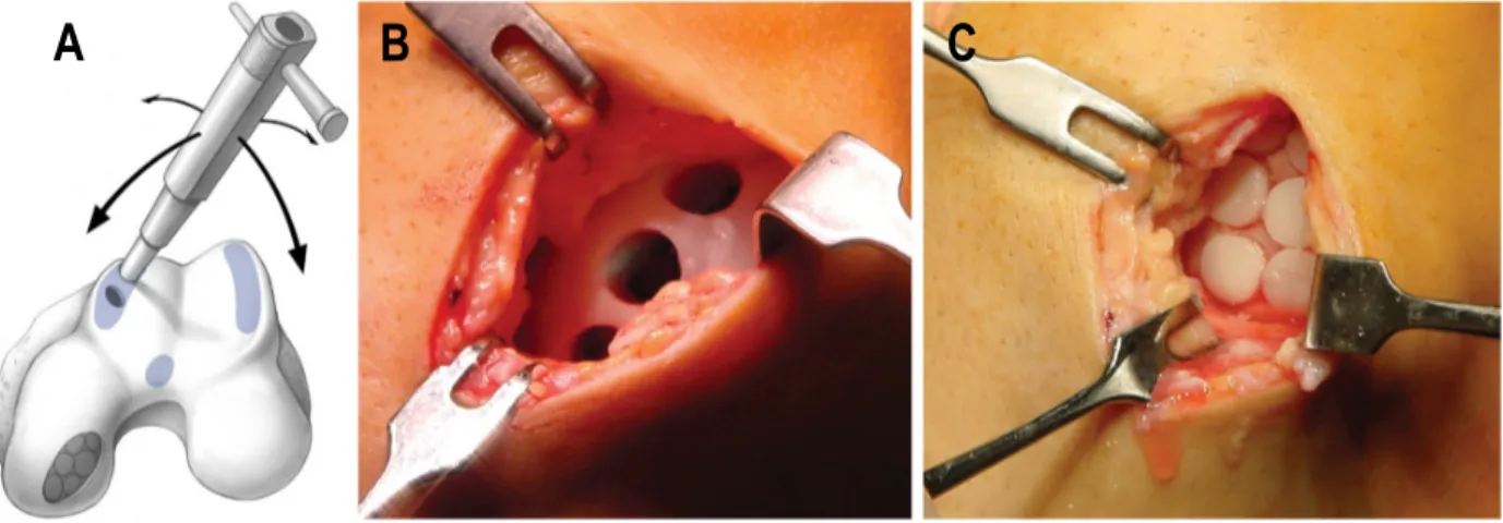 Figura  I7.  Etapas  de  la  técnica  de  la  mosaicoplastia.  Realización  del  cilindro  osteocondral  (A)  en  una  zona  poco  comprometida  con  la  carga;  exposición  de  la  región  que  recibirá  el  implante  (B); 