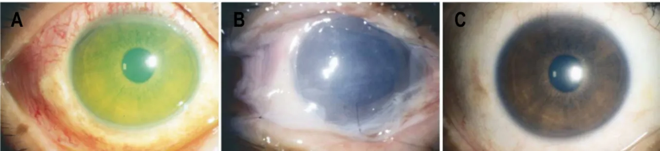 Figura  I17:  Fases  del  tratamiento  de  una  quemadura  ocular  con  la  MA.  Epitelio  conjuntival  denudado (A); primer día tras realizar el trasplante de MA (B); un mes después del tratamiento con  la superficie conjuntival totalmente recuperada