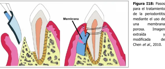 Figura  I18:  Pasos  para  el  tratamiento  de  la  periodontitis  mediante  el  uso  de  una  membrana  porosa