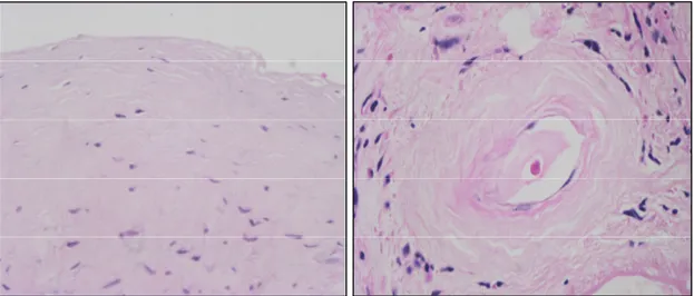 Figura 2. Imágenes características del peritoneo de pacientes en DP. En la imagen de  la izquierda, se evidencia pérdida mesotelial y celulas fibroblásticas en un espacio  submesotelial fibrosado con aspecto homogéneo