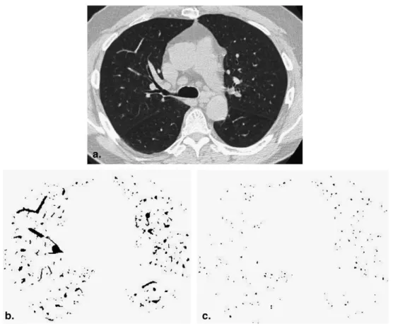 Figure 1. The method of measuring the cross-sectional area of small pulmonary vessels using ImageJ software