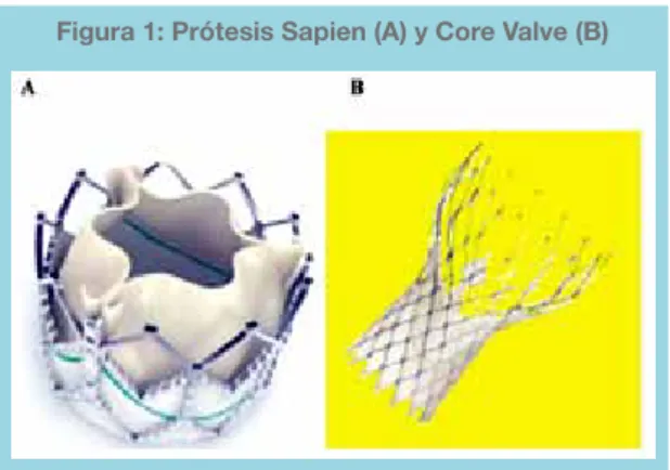 Tabla N°1: Tipos de prótesis valvulares