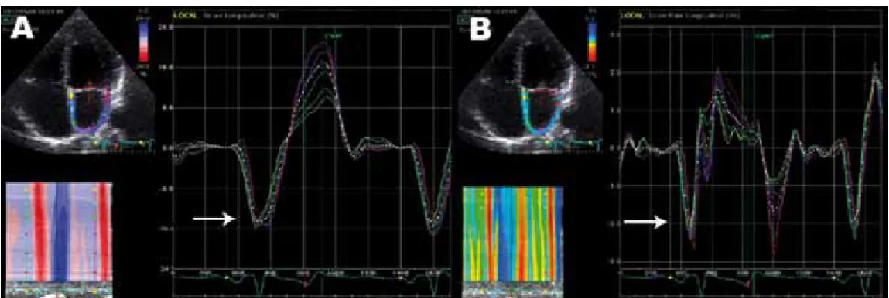 Figura 1A. Se muestra la curva de strain auricular izquierdo y mediante el trazado electrocardiográfico se logra identificar (flecha) el por- por-centaje de deformación que se produce durante el sístole auricular (SaAI) y durante el sístole ventricular (Ss