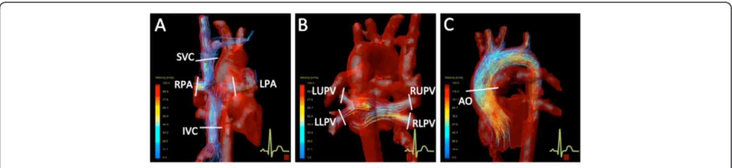 Figure 2 4D velocity acquisition plane location for flow investigation. (A) Anterior view of the Fontan circuit and aortic arch with visualized pathlines within the IVC, LPA, RPA and SVC