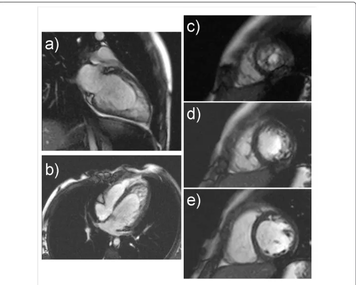 Figure 4 A five years old female with EF 41.5%. Steady-state free precession magnetic resonance imaging in a Long Axis (a), four-chamber (b) and short-axis (c, d, e) views demonstrate extensive trabeculations of the LV wall in the basal (e), mid (d) and ap