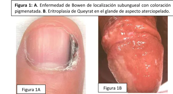 Figura 1: A. Enfermedad de Bowen de localización subungueal con coloración  pigmenatada