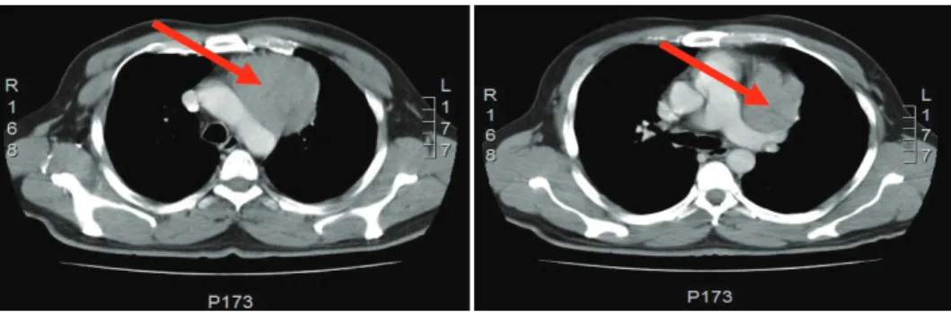 Figure 1: Computed Tomography of the chest shows the presence of an anterior mediastinal solid mass (red arrow) that has a maximum diam- diam-eter of 7.5 cm