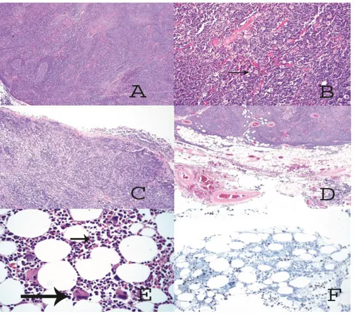 Figure 2: (A) Solid tumor made up of lymphocytes with germinal center formation.  (B) At higher magnification, (arrow) large cells of clear  eosinophilic cytoplasm and round nuclei (epithelial cells) are also observed