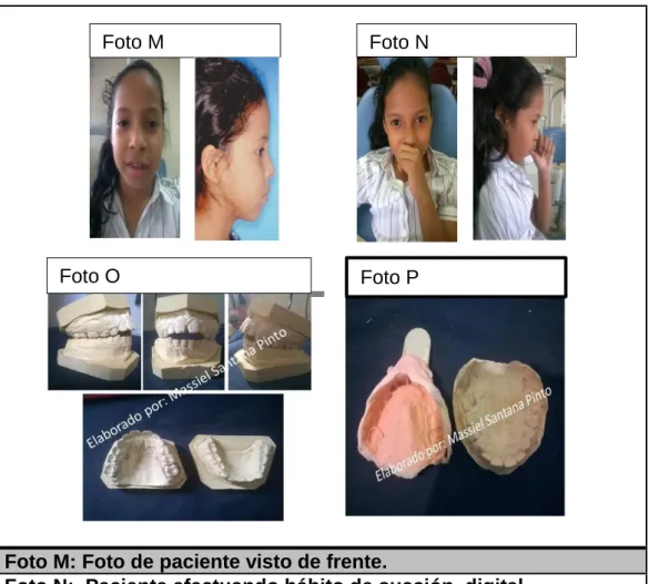 Foto N:  Paciente efectuando hábito de succión  digital  Foto O: Modelo de trabajo visto en diferentes ángulos