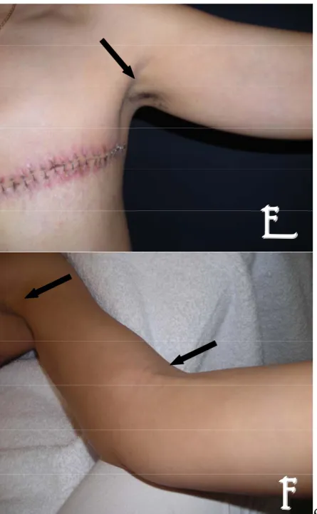 Figure 1. (A) Patient demonstrating axillary web syndrome in left arm with taut  cords in the axilla