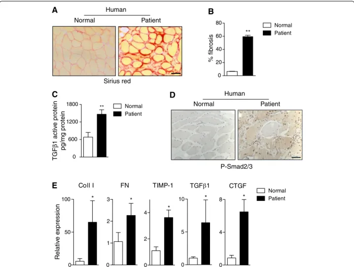 Figure 1 Quantification of fibrosis in human dystrophic muscle. (A) Representative Sirius red staining of healthy and dystrophic human muscle sections reveals the extent of collagen deposition in patients with Duchenne muscular dystrophy (DMD)
