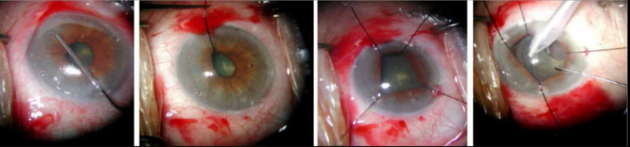 Ilustración 1.- Secuencia típica de una cirugía de catarata en un paciente que presentó un síndrome de  iris flácido intraoperatorio