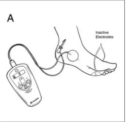 Figura 1.4.  Aplicación percutaneous tibial nerve stimulation (PTNS). Modificada de Peters  (37) 