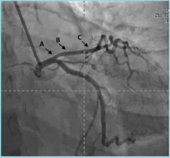 Figura 1. Electrocardiograma de 12 derivaciones tomado unas  horas después del paro cardíaco