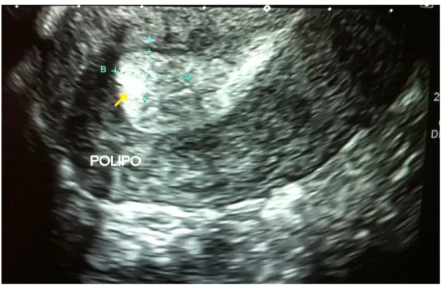 Fig.  nº 1: Pequeño pólipo endometrial deformando la línea media endometrial.  