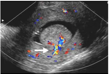 Fig. nº 9: Pólipo endometrial con un pedículo vascular. 