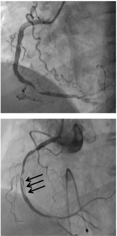 Figura  7.  Ejemplos  de  pacientes  con  baja  y  alta  carga  trombótica  tras  la  repermeabilización  del  vaso  con  la  guía  de  angioplastia