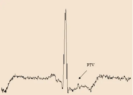 Figura 1. 3. Ubicación de los PTV en la señal ECG 