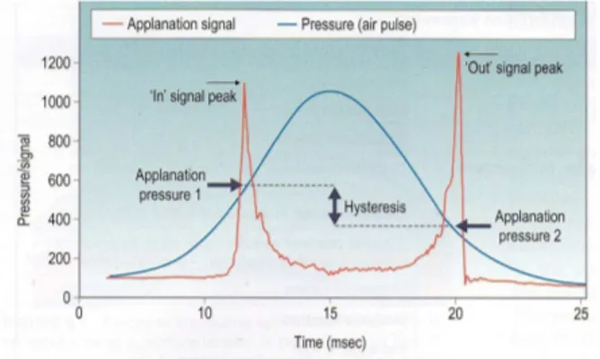 Fig  11:  Gráfica  de  señal/aplanación  del  tonómetro  ORA  y  de  la  que  se  obtienen  medidas  de  la 