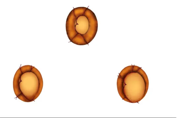 Figura 21: Daño óptico glaucomatoso. 