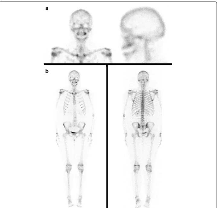 Fig. 5 Bone scintigraphy showed an increase in osteoblast activity in the left maxillary bone, related with the known bone injury