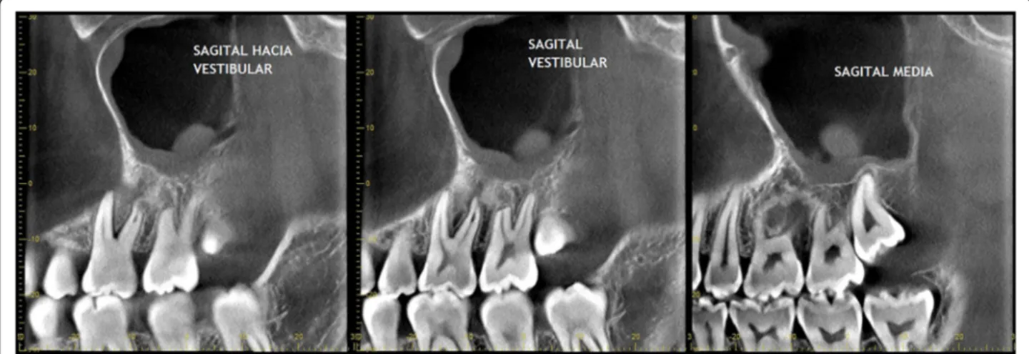 Fig. 6 CT images of sinus commitment, after the biopsy and before complete surgical removal of the lesion