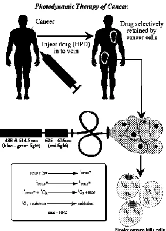 Figura I-2: Terapia Fotodinámica [6] : Visión general del tratamiento humano de celulas  malignas mediante terapia fotodinámica