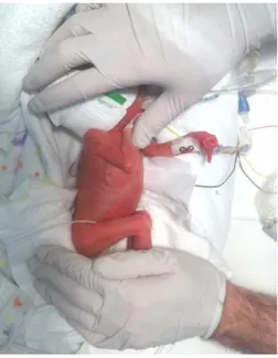 Figura 12. Recién nacida prematura del Servicio de Neonatología del Hospital 12 de Octubre 