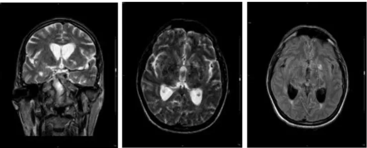 Figura 1. Imágenes de la RMN cerebral del paciente. 