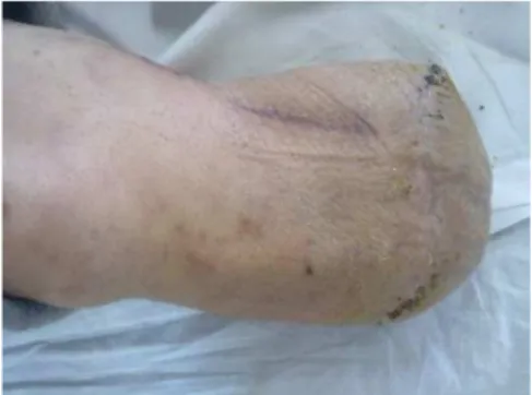 Figura  2.2. Muñón cicatrizado.  Estado del muñón de  un paciente  tras haberle quitado los puntos  de sutura