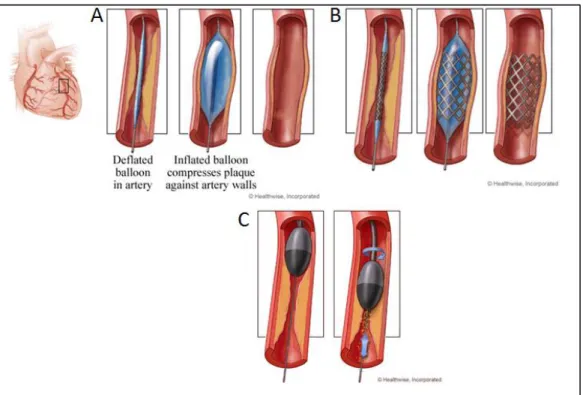 Figure  1-6:  Percutaneous  coronary  interventions..  (A)  Balloon  angioplasty  (Healthwise  Staff,  2015a)