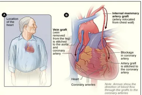 Figure 1-7: Coronary Artery Bypass Surgery. (A) Location of the heart. (B) How  vein saphenous vein and internal mammary artery bypass grafts are attached to the 
