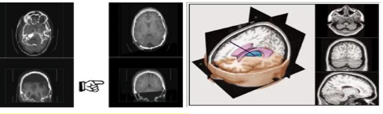 Figura  4.  Imagen  de  epilepsia  con  la  visualización  de  los  electrodos  etiquetados  en  un  ambiente de 3D