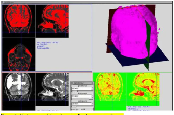 Figura 9.  Varios cortes del cerebro visualizados en este software. 