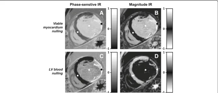 Fig. 1 Phase-sensitive inversion-recovery (PSIR) and magnitude IR late gadolinium enhancement (LGE) images with viable myocardium nulling and blood nulling