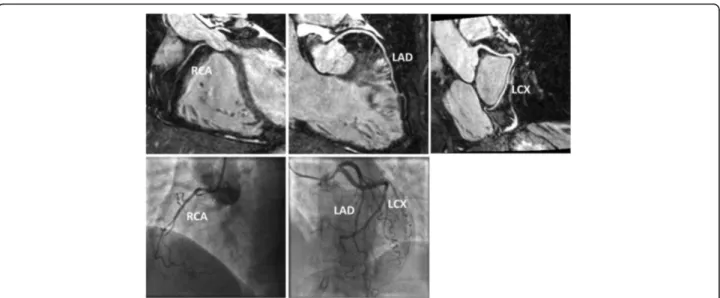 Fig. 1 Reformatted CMRA datasets (top row) from a patient without coronary artery disease but non dominant right coronary artery (RCA).