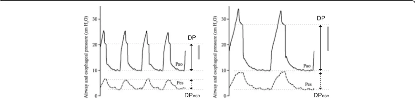 Fig. 1 Airway (P ao ) and esophageal (P eso ) pressures in a patient with pneumonia and ARDS under volume-controlled ventilation with Vt 6 (left) and Vt 12 (right) mL/kg IBW and similar PEEP